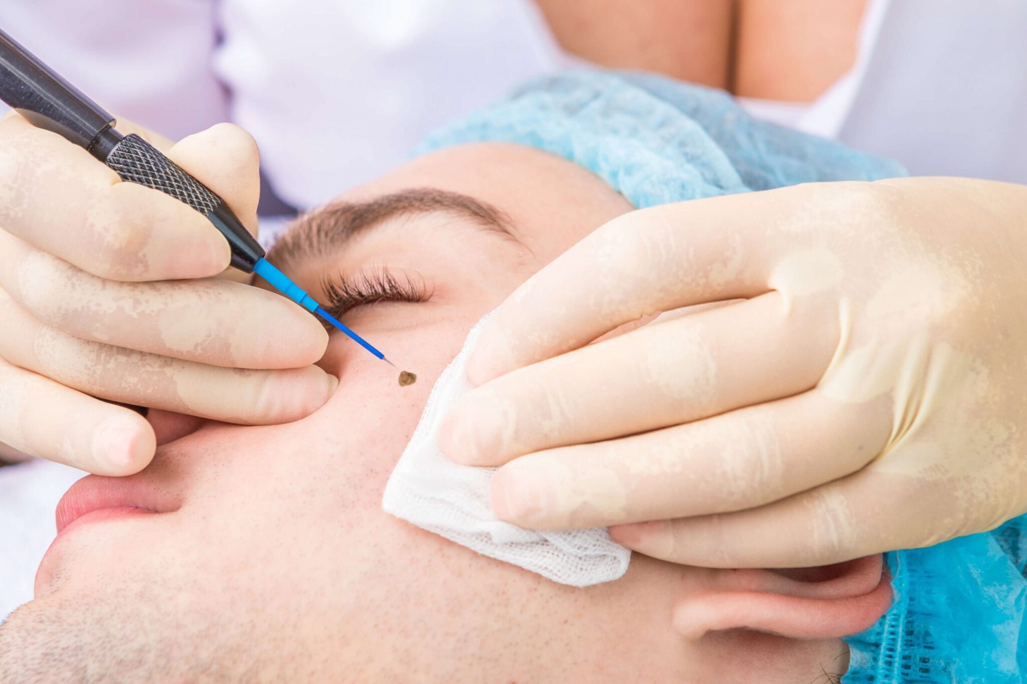 Electrosurgical Mole Removal Procedure